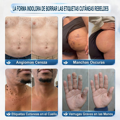 𝐏𝐢𝐜𝐝𝐨®🖤🍰Borrador de Verrugas y Manchas en 7 Días (𝐀𝐩𝐥𝐢𝐜𝐚𝐝𝐨𝐫 𝐫𝐨𝐥𝐥-𝐨𝐧: 𝐬𝐢𝐧 𝐝𝐨𝐥𝐨𝐫 𝐧𝐢 𝐜𝐢𝐜𝐚𝐭𝐫𝐢𝐜𝐞𝐬)